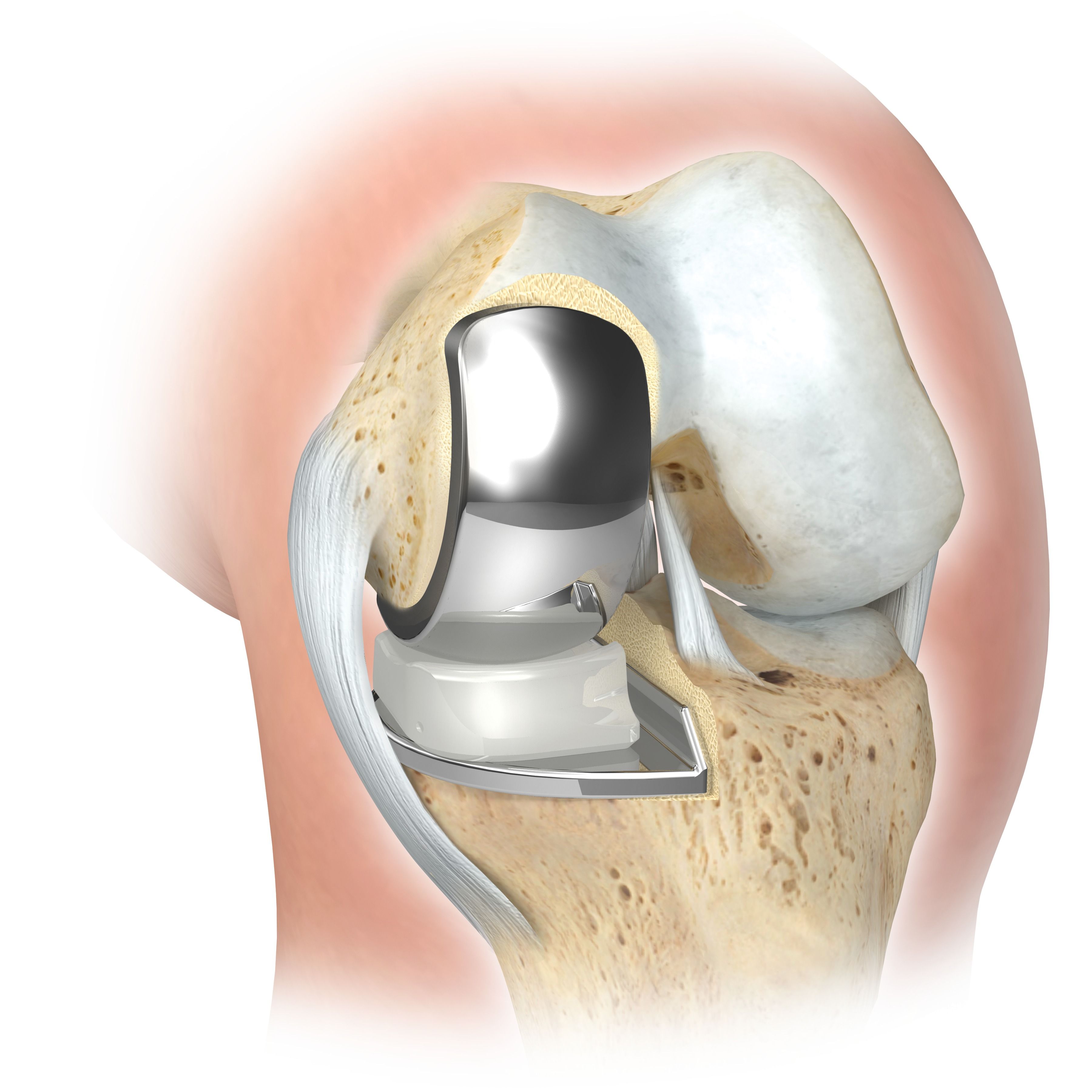 Knieteilprothese innen