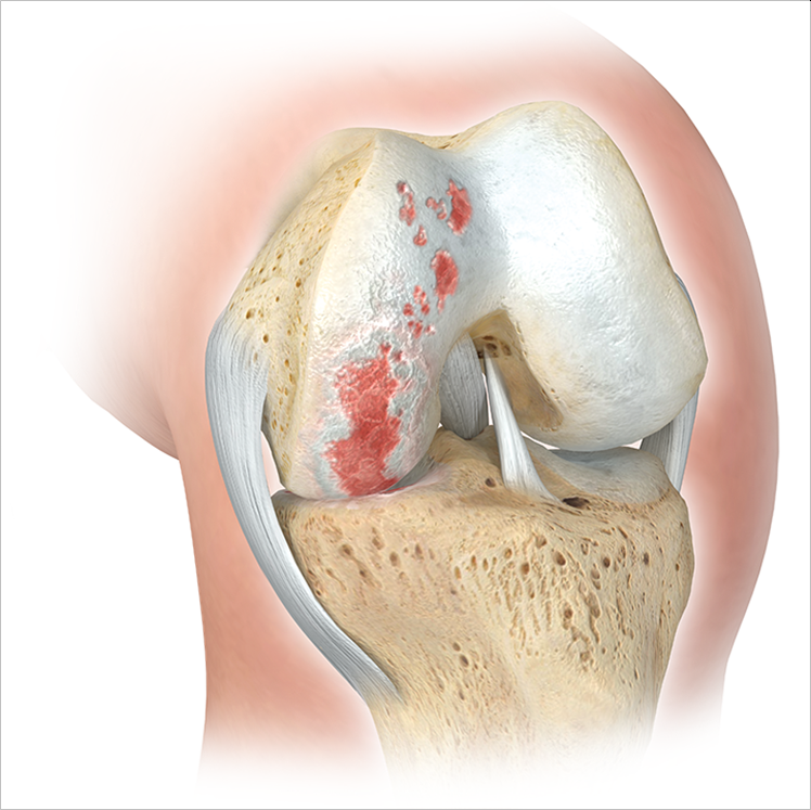 Arthrose isoliert innenseitig